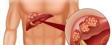 cancer hepatic