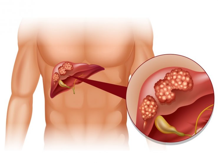 cancer hepatic