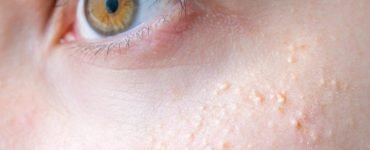 puncte de grasime 1140x500 1