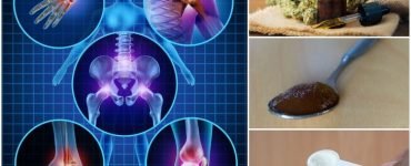 arthritis remedies