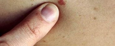 tratare piele