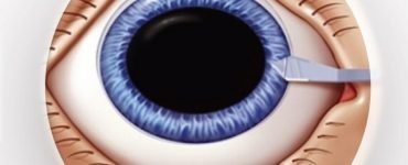 cataracta 750x430