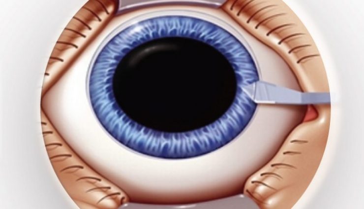 cataracta 750x430