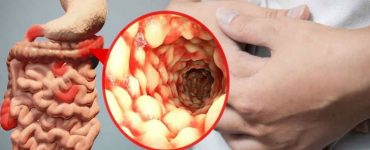 crohn boala