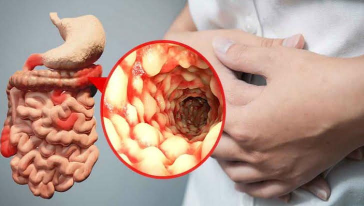 crohn boala