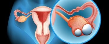 cancer ovare