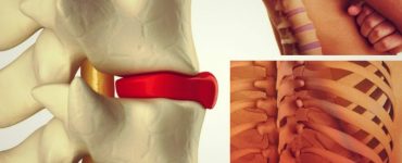 hernia