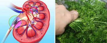 kidney stone parsley