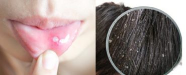 lipsa vitamine
