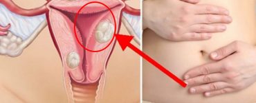 Ce este endometrioza si de ce se mai numeste si boala femeilor neiubite