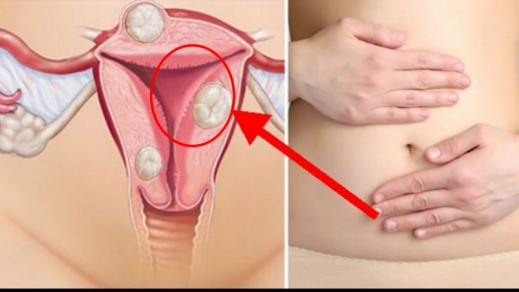 Ce este endometrioza si de ce se mai numeste si boala femeilor neiubite