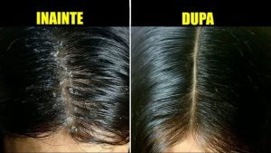 Remedii eficiente pentru mătreață 4 inainte dupa