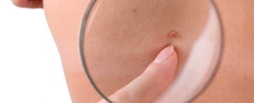 skin cancer symptoms 1000x600