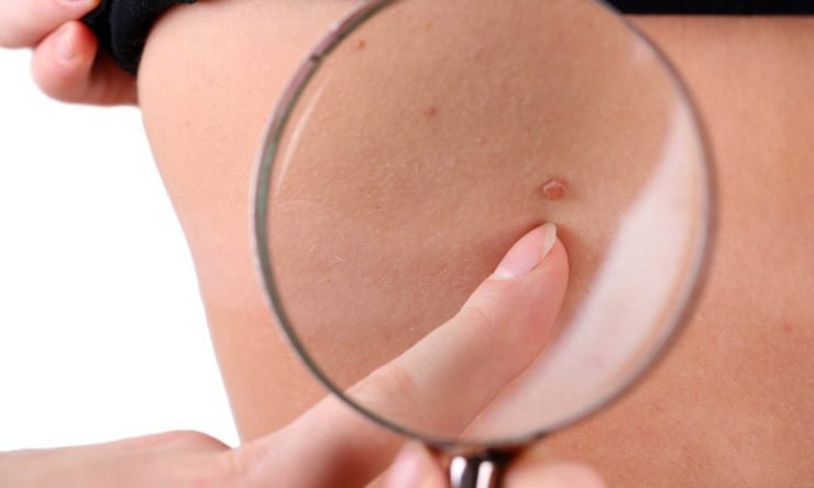 skin cancer symptoms 1000x600