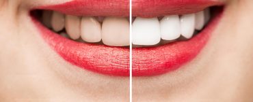 white teeth
