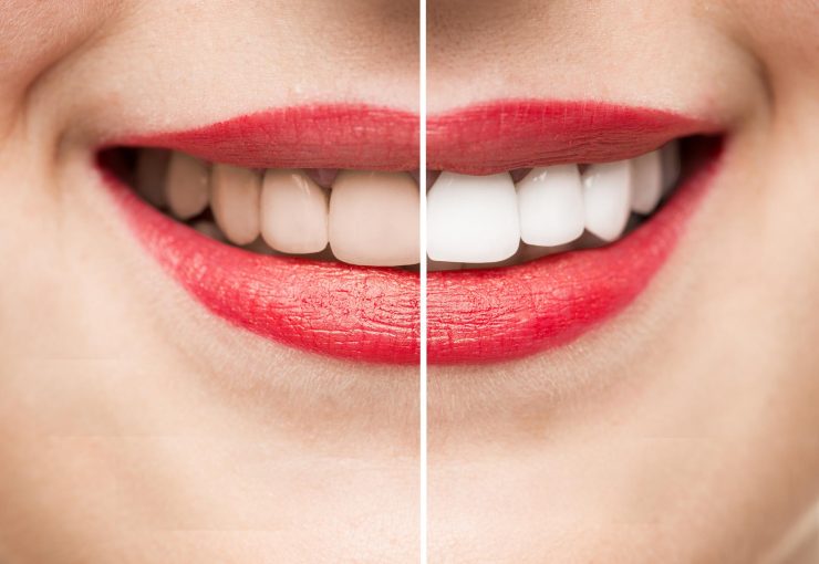 white teeth