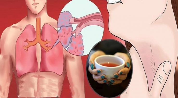 Remediu pentru tuse si inflamatia plamanilor mai puternic decat orice sirop