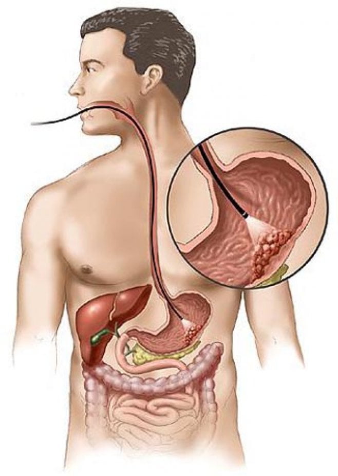 cancer la stomac