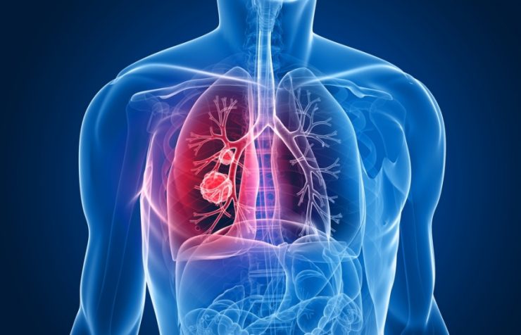 ce este cancerul pulmonar
