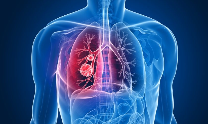 ce este cancerul pulmonar