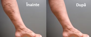 cum scapi de varice