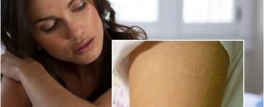 keratosis pilaris