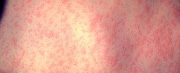 morbillivirus measles infection