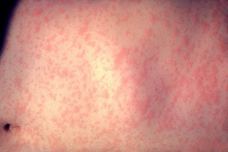 morbillivirus measles infection