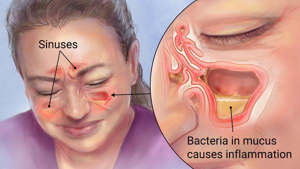 sinuses