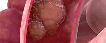 6 simptome ale CANCERULUI DE COLON