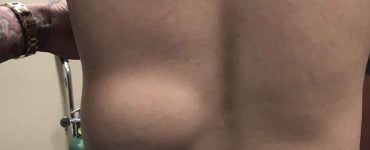 lipom 1024x483