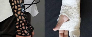 osteoid gips 3 d