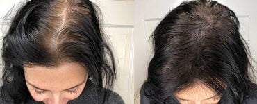 Scalp 1 732x549 Thumbnail