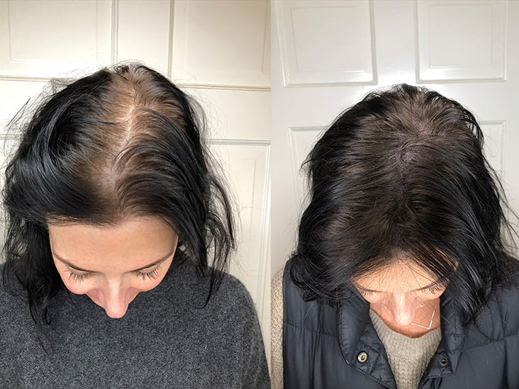 Scalp 1 732x549 Thumbnail