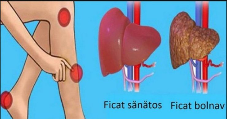 ficat