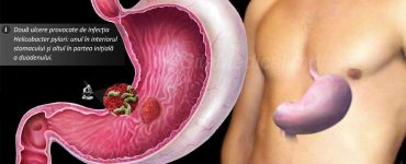 ulcer gastric si duodenal md