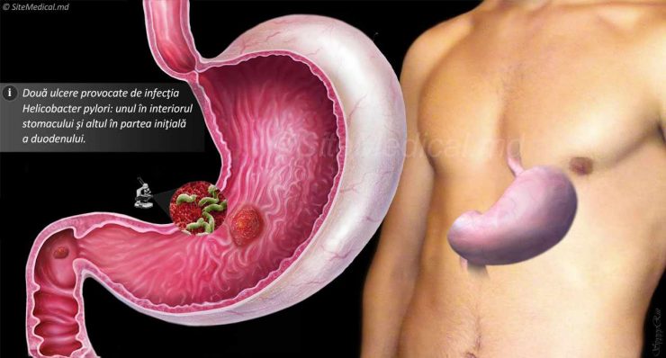 ulcer gastric si duodenal md
