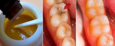 5 simple steps reverse cavities heal tooth decay naturally