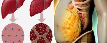 semne detoxifiere ficat