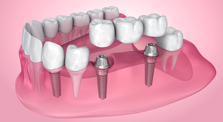 rana art dent implantologie si coroane dentare