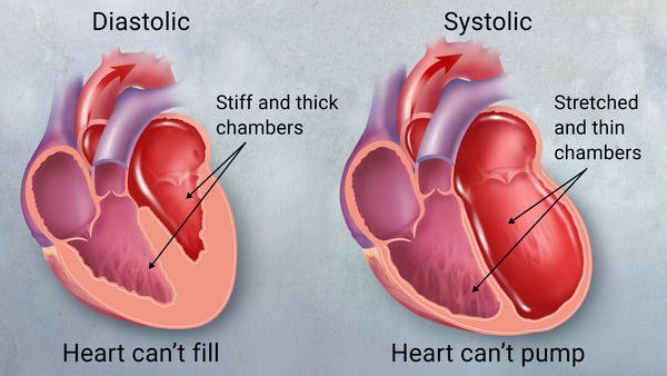Insuficienta cardiaca sistolica si diastolica mecanism