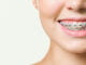 Cum te poate ajuta aparatul dentar sa ti schimbi viata