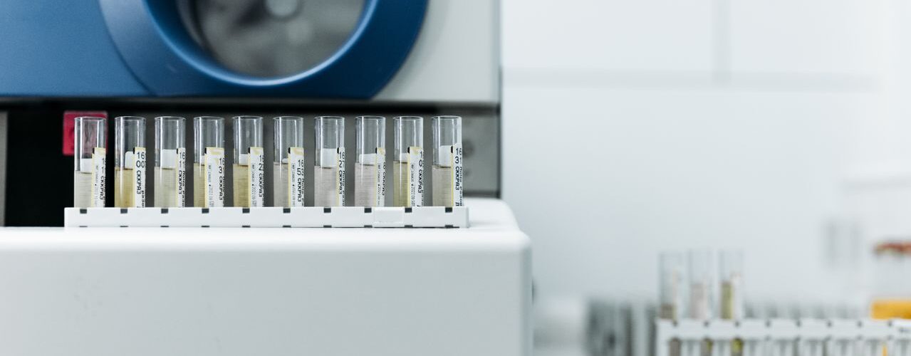 Porfobilinogen: ce arată analiza și când e recomandată?